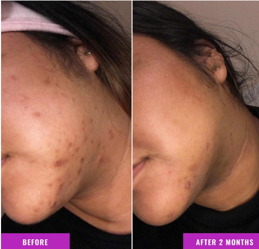 What Removes Pigmentation on Face?